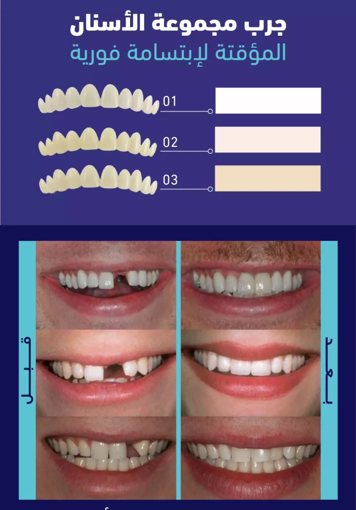 لصقات الأسنان المؤقتة - طنجة 360
